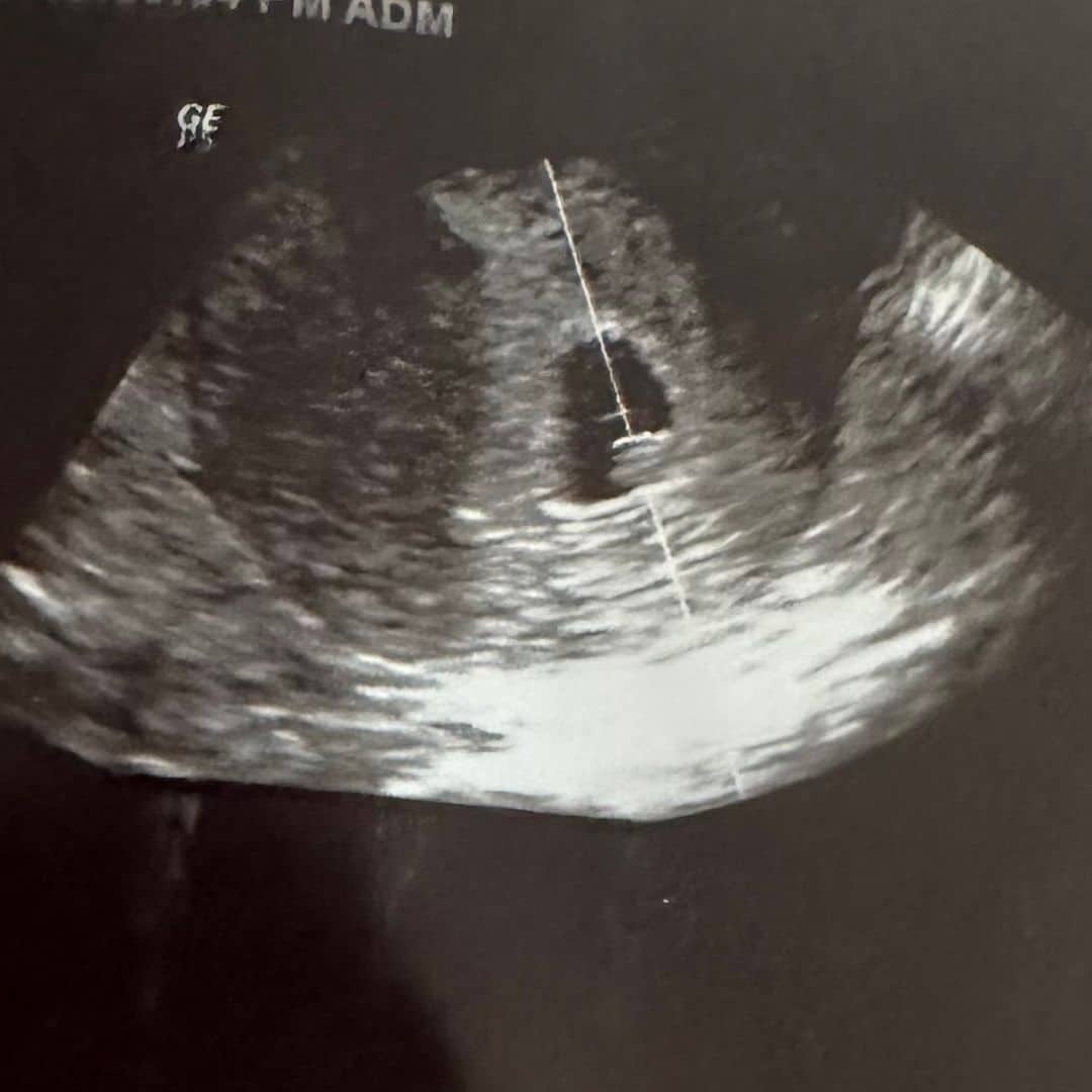 pregnancy ultrasound image